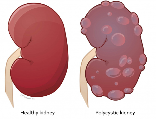 polycystic_kidney_disease_2018-02