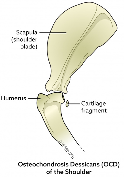 osteochondrosis treatment options)