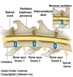 how is spondylosis in dogs treated