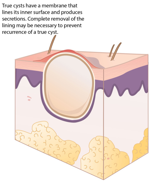 Top 10+ treating sebaceous cysts in dogs 4 Cysts | VCA Animal Hospital