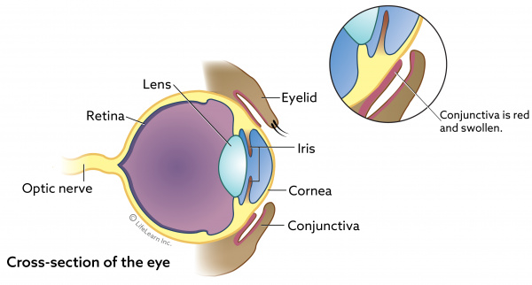Top 17 symptoms of dog pink eye 7 Conjunctivitis in Dogs | VCA Animal Hospital