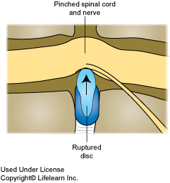 how can you tell if your dog has a slipped disc