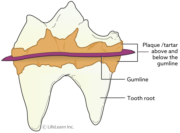tooth-plaque_updated2017-01